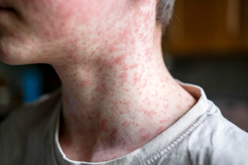 Measles viral disease human skin covered with measles rash vaccination concept