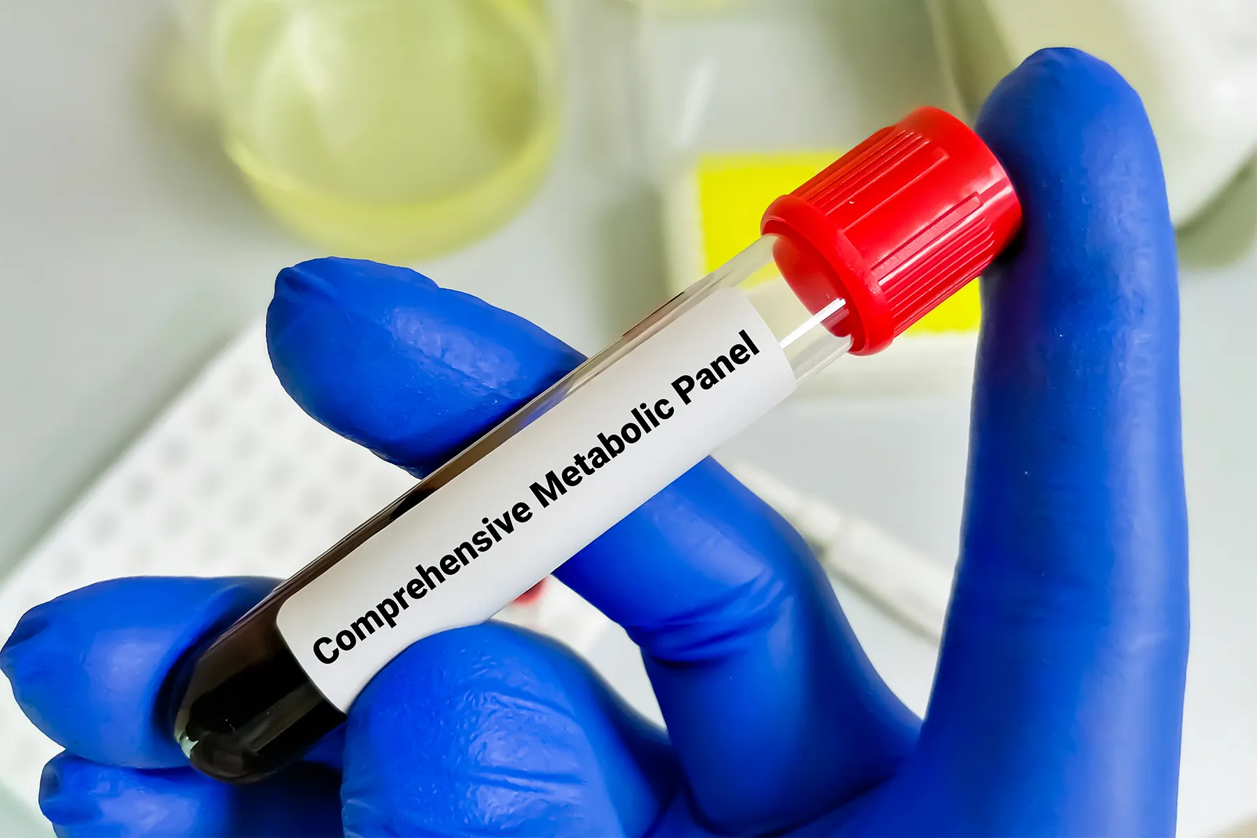 Comprehensive Metabolic Panel blood test