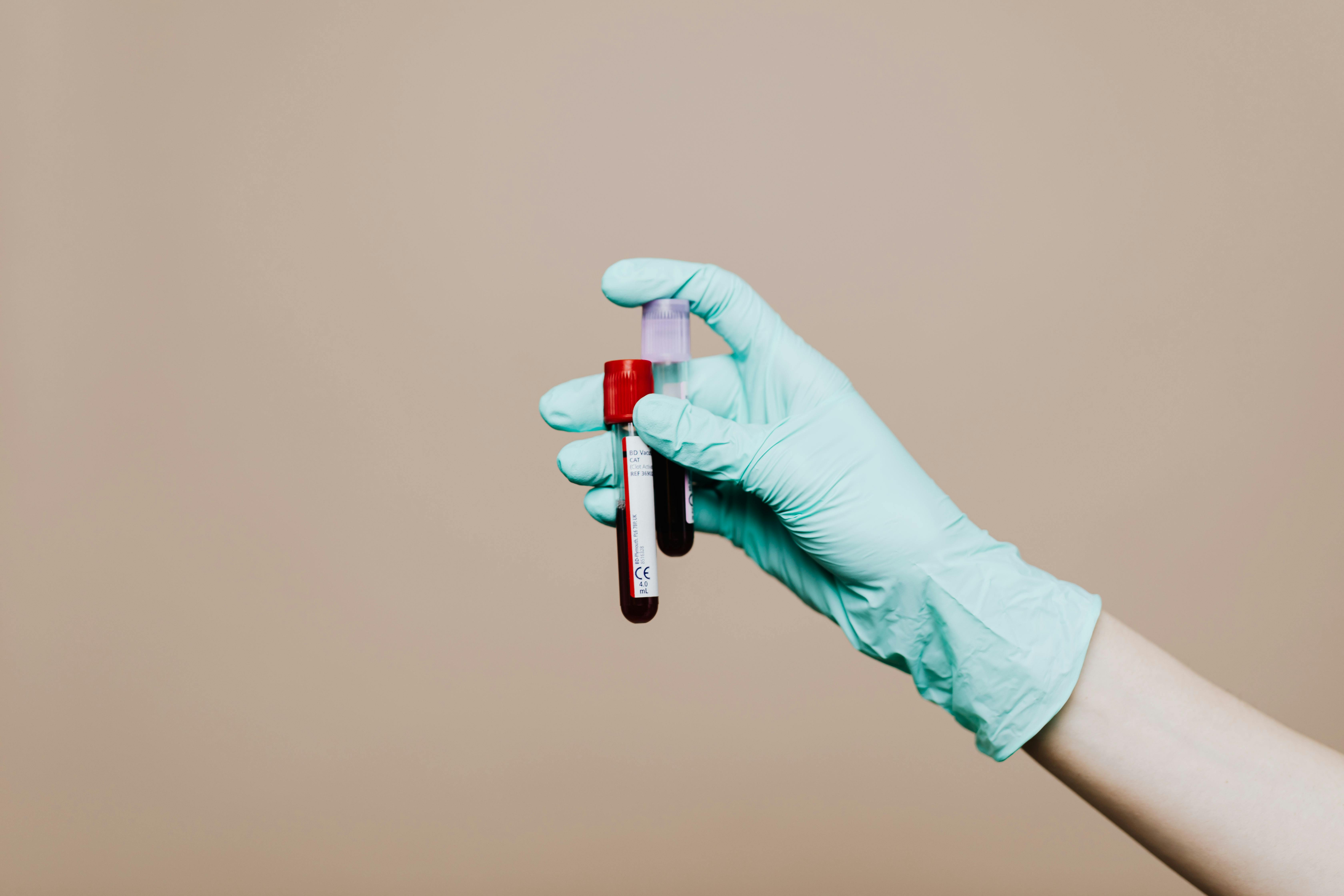 Estradiol E2 blood test tube in a medical laboratory